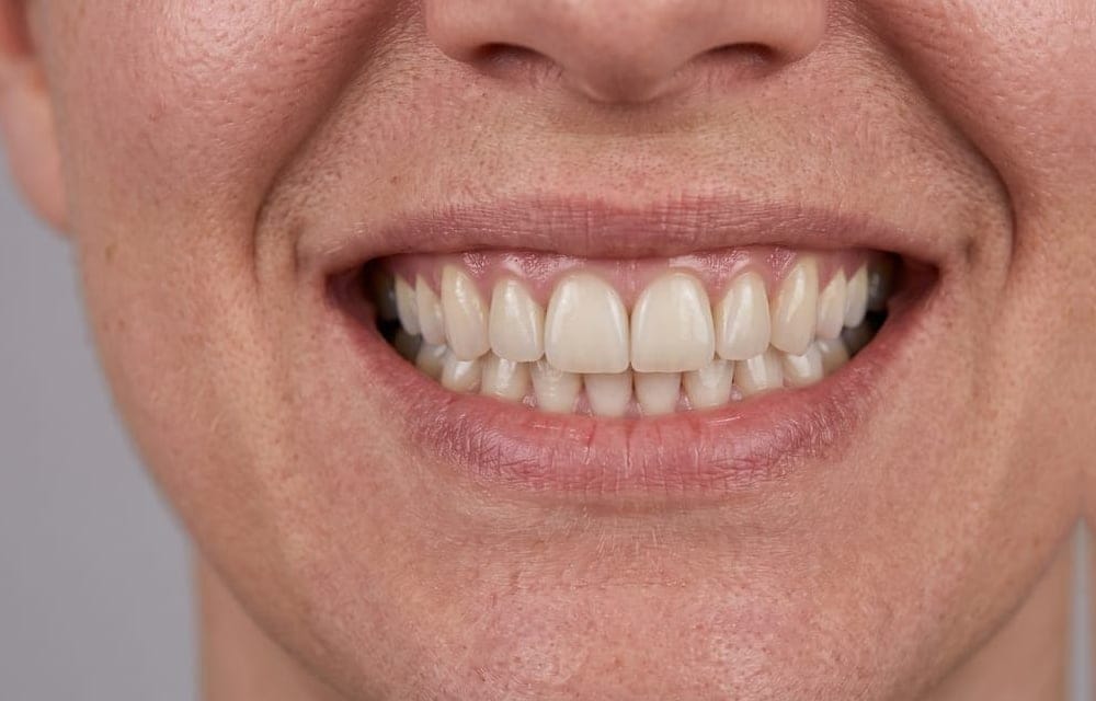 بعد العلاج — تبييض واستعادة اللون الطبيعي